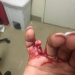 Open Dislocation of Fifth Digit 2 5th Finger Dislocation Photograph JETem 2016