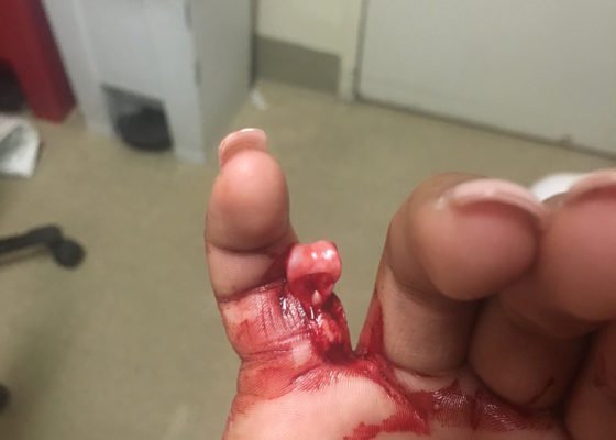 Open Dislocation of Fifth Digit 2 5th Finger Dislocation Photograph JETem 2016