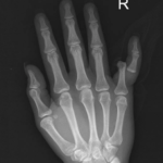 Open Dislocation of Fifth Digit 1 5th Finger Dislocation Xray JETem 2016