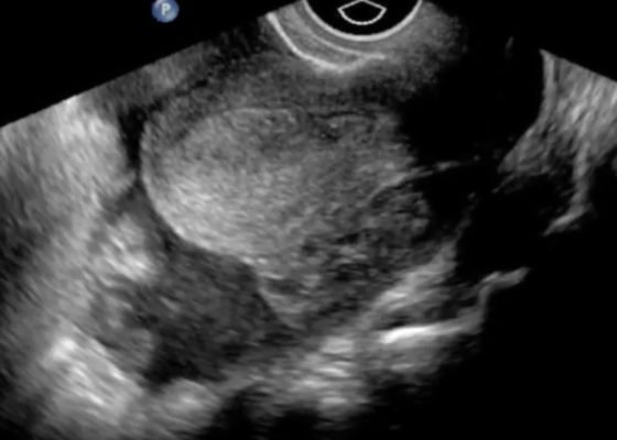 Ectopic Still JETem 2016