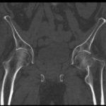 Femoral Neck Fracture, AP CT. JETem 2016