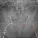 Femoral Neck Fracture, AP Xray, Annotated. JETem 2016