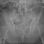 Femoral Neck Fracture, AP Xray. JETem 2016