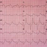 Hyperkalemia ECG JETem 2016