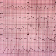 Hyperkalemia ECG JETem 2016