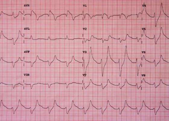Hyperkalemia ECG JETem 2016