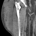 Morel Lavalee Lesion