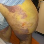 Morel Lavallee Lesion