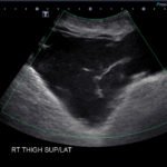 Morel Lavallee Lesion