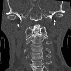 Odontoid Fracture, CT Coronal. JETem 2016