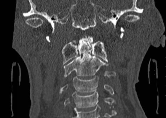 Odontoid Fracture, CT Coronal. JETem 2016