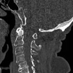 Odontoid Fracture, CT Sagittal. JETem 2016