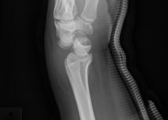 Perilunate Dislocation, XRay. JETem 2016