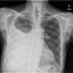Pleural Effusion, AP Chest Xray JETem 2016