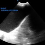 Large Right Pleural Effusion