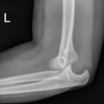 Posterior Elbow Dislocation, Lateral Xray, dislocated. JETem 2016
