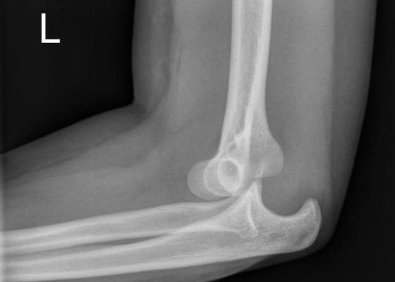 Posterior Elbow Dislocation, Lateral Xray, dislocated. JETem 2016