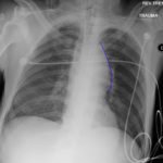 Traumatic Aortic Injury 7 Traumatic Aortic Injury. AP Chest XRay, Annotated. JETem 2016