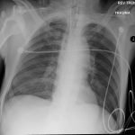 Traumatic Aortic Injury 14 Creative Commons images