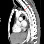 Traumatic Aortic Injury 6 Traumatic Aortic Injury. Sag CT 1, Annotated. JETem 2016