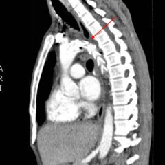 Traumatic Aortic Injury. Sag CT 1, Annotated. JETem 2016