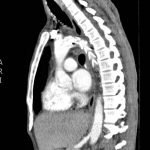 Traumatic Aortic Injury 13 Creative Commons images