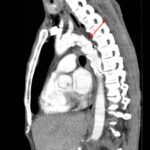Traumatic Aortic Injury 5 Traumatic Aortic Injury. Sag CT 2 Annotated. JETem 2016