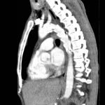 Traumatic Aortic Injury 12 Creative Commons images
