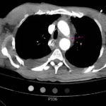 Traumatic Aortic Injury 4 Traumatic Aortic Injury. Trans CT 1, Annotated. JETem 2016
