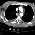 Traumatic Aortic Injury 8 Creative Commons images