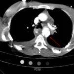 Traumatic Aortic Injury 1 Traumatic Aortic Injury. Trans CT 2, Annotated. JETem 2016