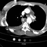 Traumatic Aortic Injury 9 Creative Commons images