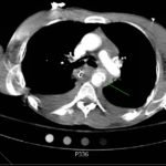 Traumatic Aortic Injury 3 Traumatic Aortic Injury. Trans CT 3, Annotated. JETem 2016