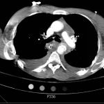 Traumatic Aortic Injury 10 Creative Commons images