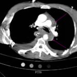 Traumatic Aortic Injury 2 Traumatic Aortic Injury. Trans CT 4, Annotated. JETem 2016