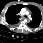 Traumatic Aortic Injury 11 Creative Commons images