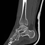 Trimalleolar Fracture, Lateral CT. JETem 2016