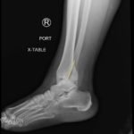 Trimalleolar Fracture, Lateral XRay, Annotated. JETem 2016