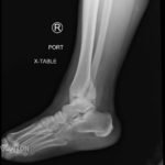 Trimalleolar Fracture, Lateral XRay. JETem 2016