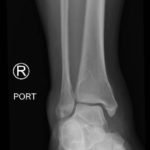 Trimalleolar Fracture, Oblique XRay. JETem 2016