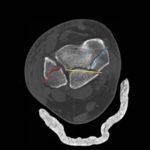 Trimalleolar Frcture, Transverse CT, Annotated. JETem 2016