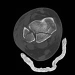 Trimalleolar Frcture, Transverse CT. JETem 2016