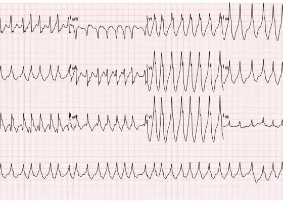 WPW EKG 1, initial EKG. JETem 2016