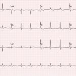 WPW EKG 3, after procainamide infusion. JETem 2016