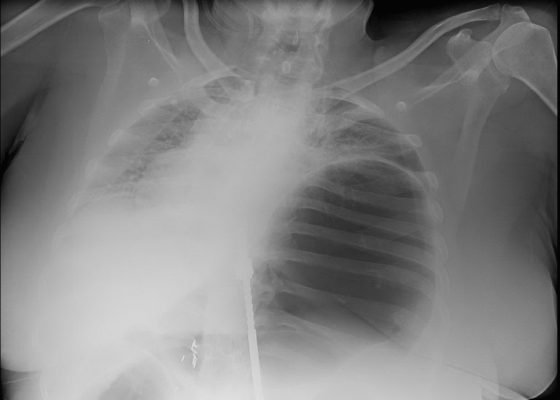 An Elderly Female with Dyspnea and Abdominal Pain 2 Creative Commons images
