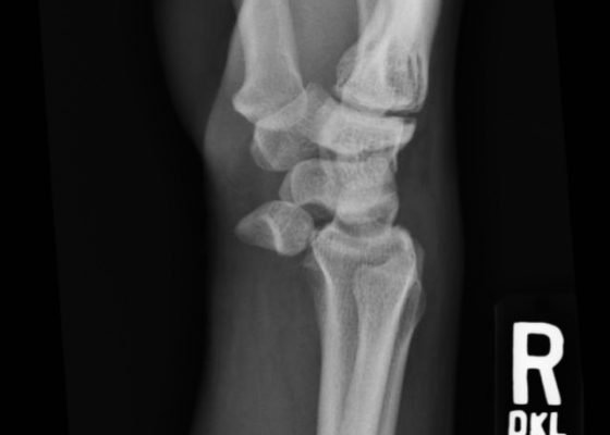 Lunate Dislocation 16 Creative Commons images