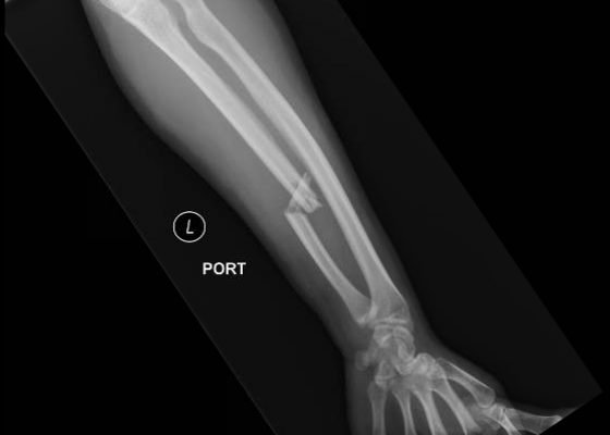 Monteggia Fracture in an Assault Patient 2 Creative Commons images