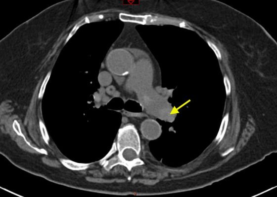 Pulmonary Embolism: Diagnosis by Computerized Tomography without Intravenous Contrast 4 Creative Commons images