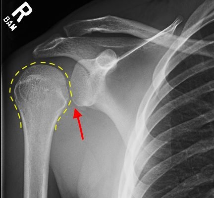Irreducible Traumatic Posterior Shoulder Dislocation 6 Creative Commons images