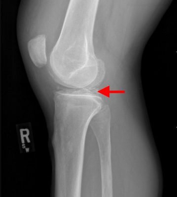 Pseudogout and Calcium Pyrophosphate Disease 8 Creative Commons images